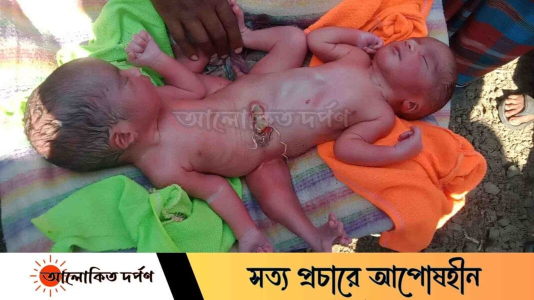 মাগুরার শ্রীপুরে জোড়া লাগানো অলৌকিক শিশুর জন্ম, পরিবার অসহায় মাগুরার শ্রীপুরে জোড়া লাগানো অলৌকিক শিশুর জন্ম, পরিবার অসহায়